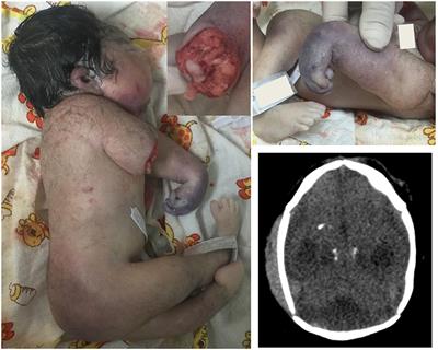 Case Report: Congenital Arthrogryposis and Unilateral Absences of Distal Arm in Congenital Zika Syndrome